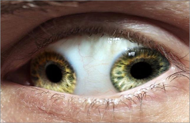 This is an image of Pupula Duplex condition of an eye, where a person will develop two irises, corneas, and retinas on the same eyeball of each eye.